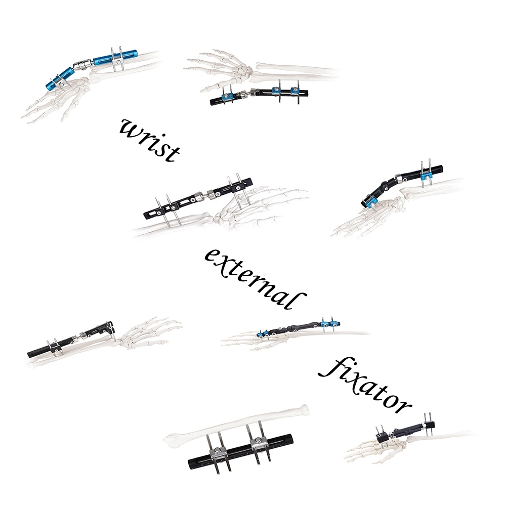 Single-Sided Integrated Wrist External Fixator (Half ball connection type)